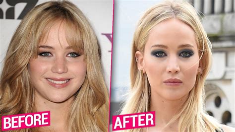 jennifer lawrence before surgery.